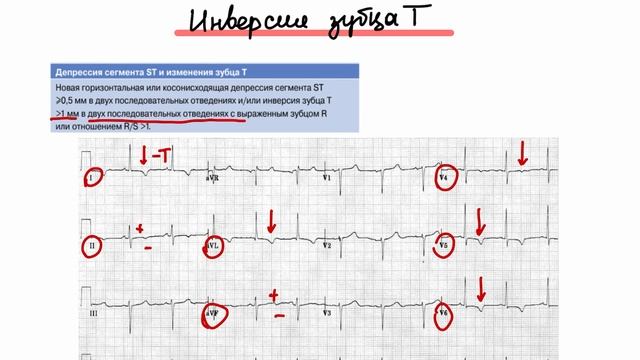 Варианты Экг Окс Без Подъема Сегмента St. смотреть онлайн
