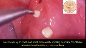 How to remove tonsil stones at home - Tonsil stone removal
