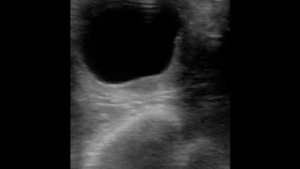 двойная овуляция