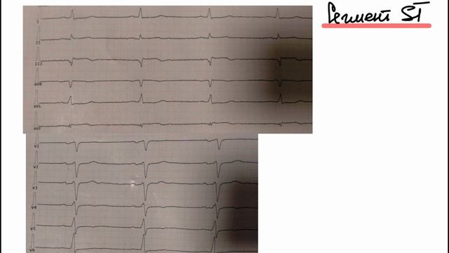 Разбор Экг От Подписчика. Нижний Инфаркт смотреть онлайн