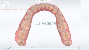 Элайнеры для выравнивания зубов До После