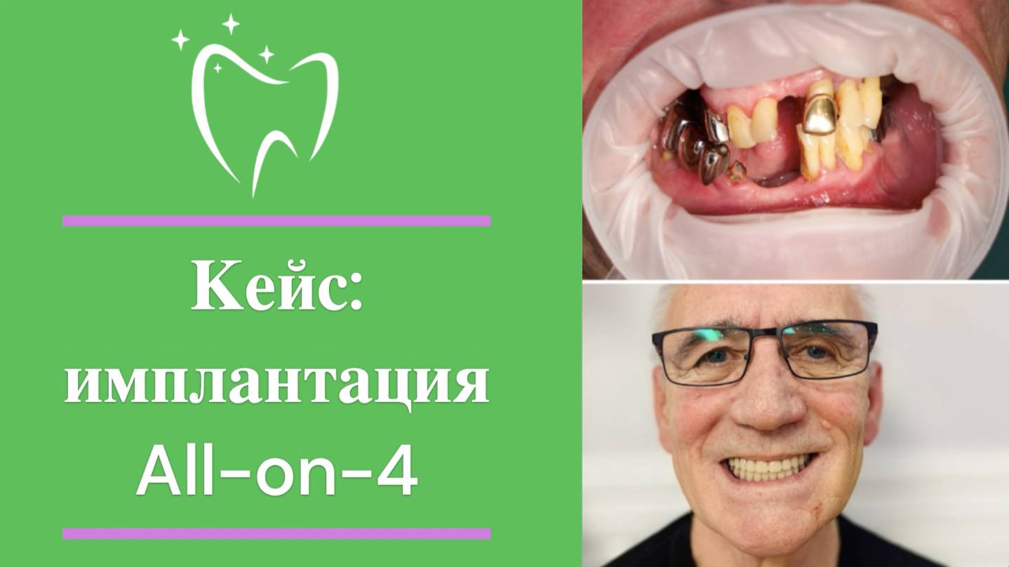💎 Кейс: имплантация All-on-4