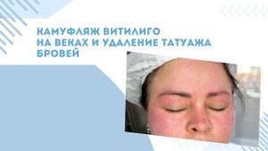 КАМУФЛЯЖ ВИТИЛИГО НА ВЕКАХ И УДАЛЕНИЕ ТАТУАЖА ЛАЗЕРОМ ЗА ОДИН ВИЗИТ