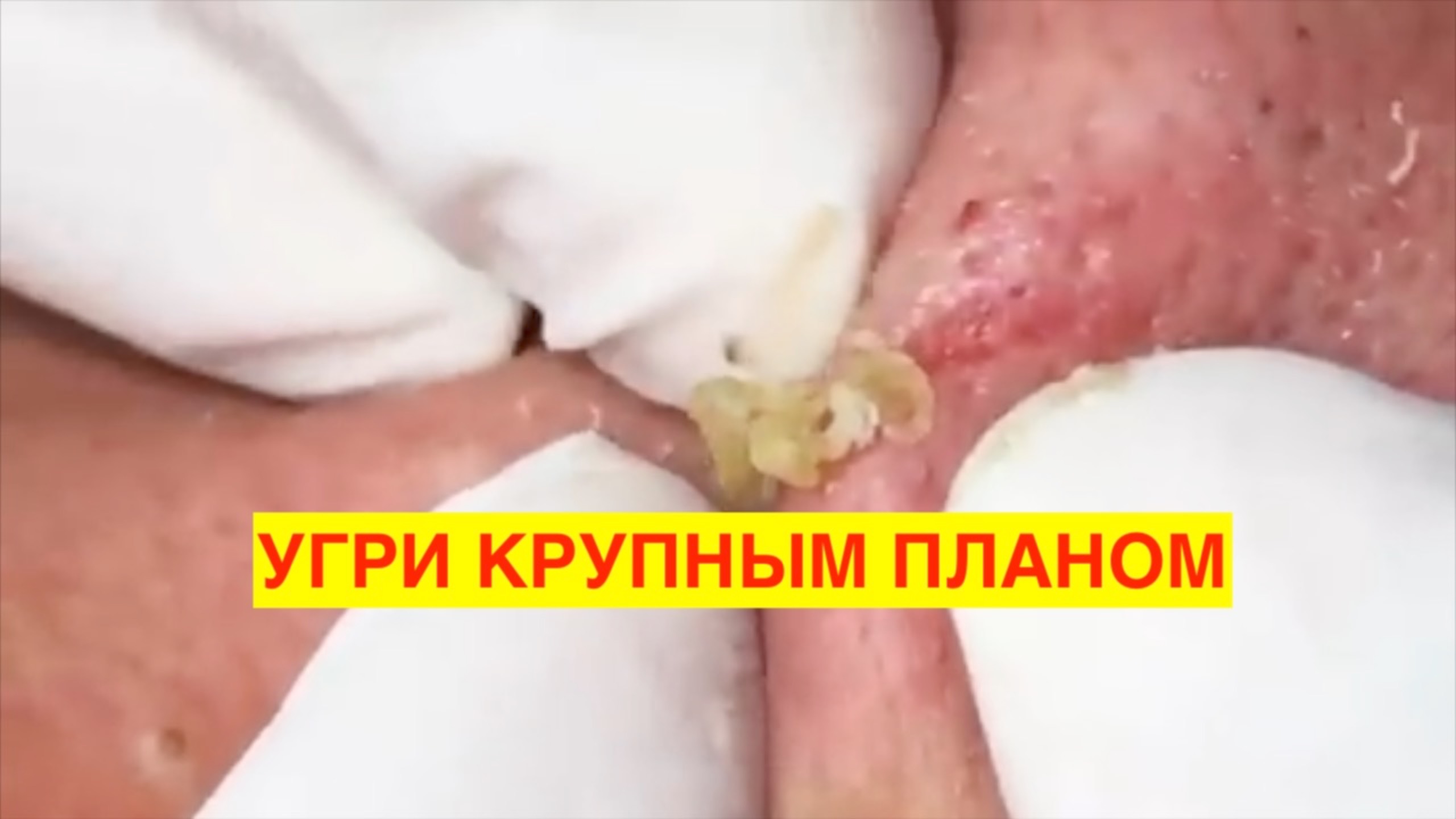УДАЛЕНИЕ УГРЕЙ КРУПНЫМ ПЛАНОМ. ПРЫЩИ. ЧИСТКА КОЖИ. Подписывайся и выиграй приз!