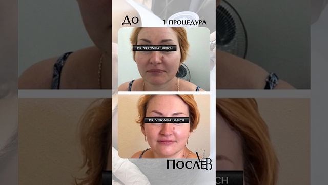 Минус 10 лет ! Без уколов!