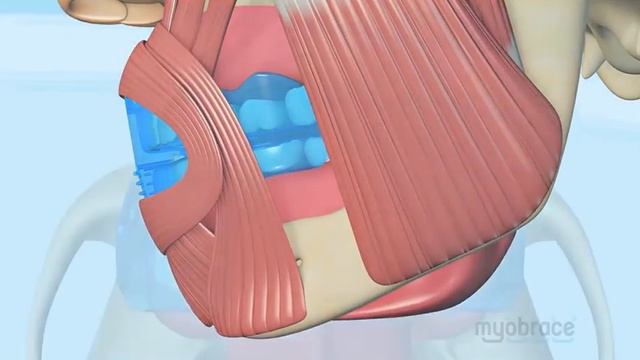 How Does Myobrace Work?