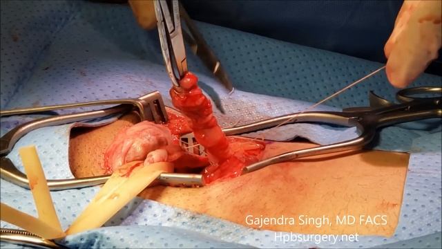 Inguinal or Groin hernia repair with mesh смотреть онлайн