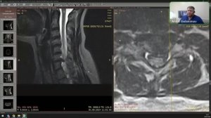 Прямой эфир "Разбор МРТ позвоночника" с Евдокимовым Антоном Сергеевичем