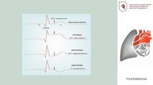 Acute coronary syndrome