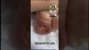 014 Вросший ноготь у младенцев Подомарафон