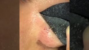 Чистка пор от черных точек