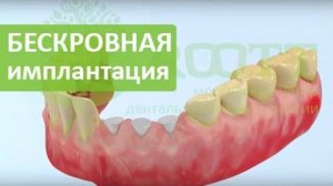 Трансгингивальная классическая имплантация