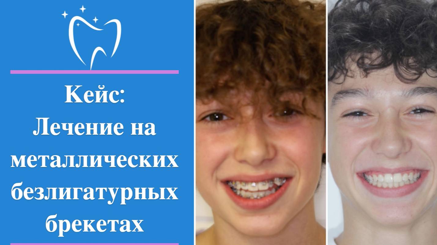 💎 Кейс: брекеты Ю.Корея