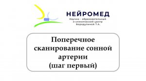 Поперечное сканирование сонной артерии в В-режиме