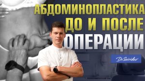 Абдоминопластика живота: удаление лишней кожи на животе. Результат До и После абдоминопластки