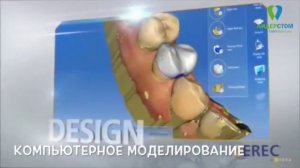Система Cerec Cad Cam. Зуб за один визит к стоматологу