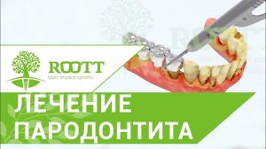 Имплантация зубов в один этап при запущенном пародонтите. ROOT