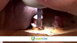 Керамические коронки на золоте не большая цена за такое качество