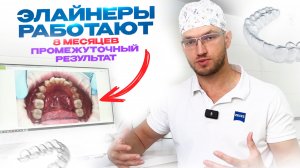 Элайнеры работают. 8 месяцев Промежуточный результат. Стас Белоус Стоматолог Ульяновск