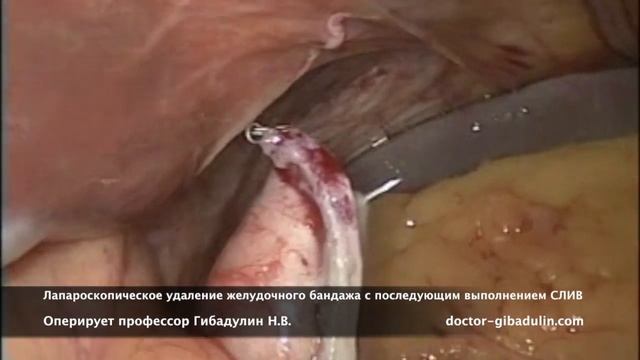 Удаление желудочного бандажа с последующей лапароскопической продольной резекцией желудка (СЛИВ)