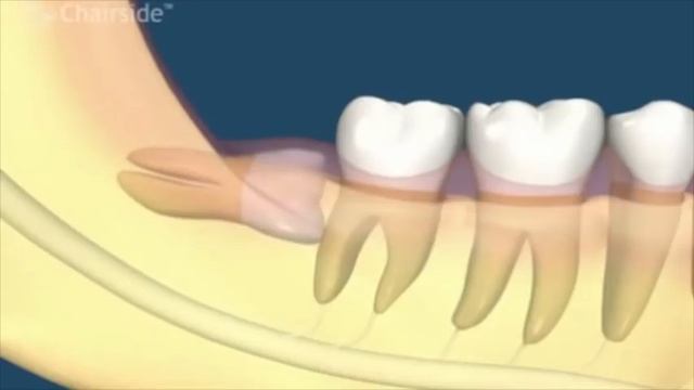 Зуб мудрости лечить или удалять? смотреть онлайн