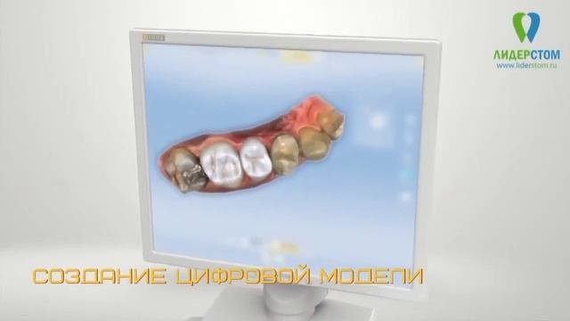 Циркониевые коронки. Протезирование по акции аппаратом Cerec