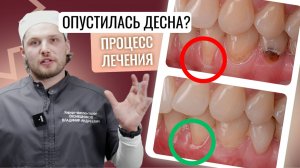 Опустилась десна? ЧТО такое рецессии и ЧТО с этим делать