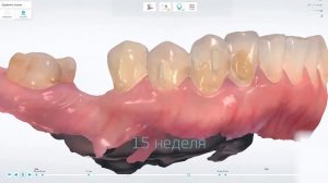 Элайнеры Москва 3D технологии Butterfly