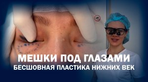 Трансконъюнктивальная пластика нижних век