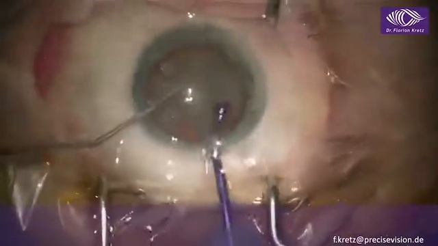 Dr. Florian Kretz: ZEPTO®️ with miLOOP and Trifocal смотреть онлайн