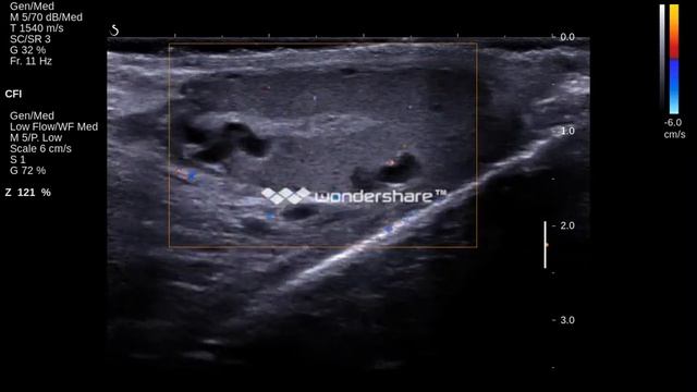 Varicocele intratesticular with Valsalva maneuver смотреть онлайн