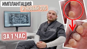 Имплантация и временный зуб СРАЗУ. Процесс операции и ВСЕ что нужно знать об этом