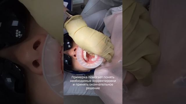 Как происходит примерка будущей улыбки?