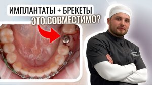 Что ставить сначала: брекеты или импланты? Показываю весь процесс на примере моего пациента