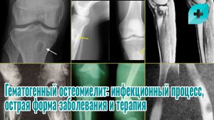 Гематогенный остеомиелит: инфекционный процесс, острая форма заболевания и терапия