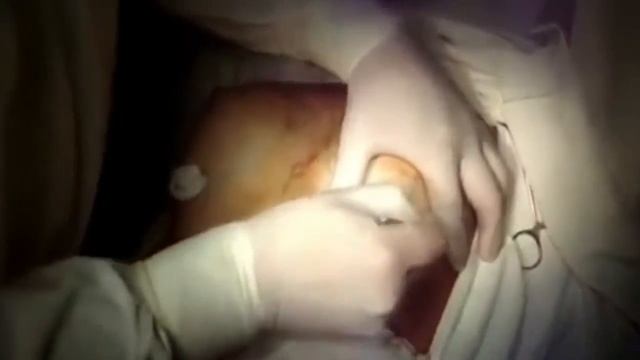 Увеличение грудей Видео смотреть онлайн