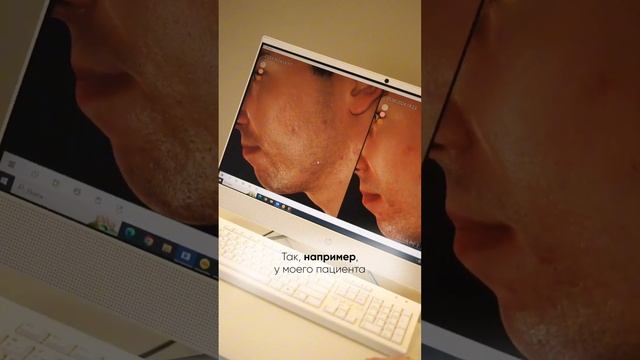 PicoCare в лечении рубцов #доктор #косметология смотреть онлайн