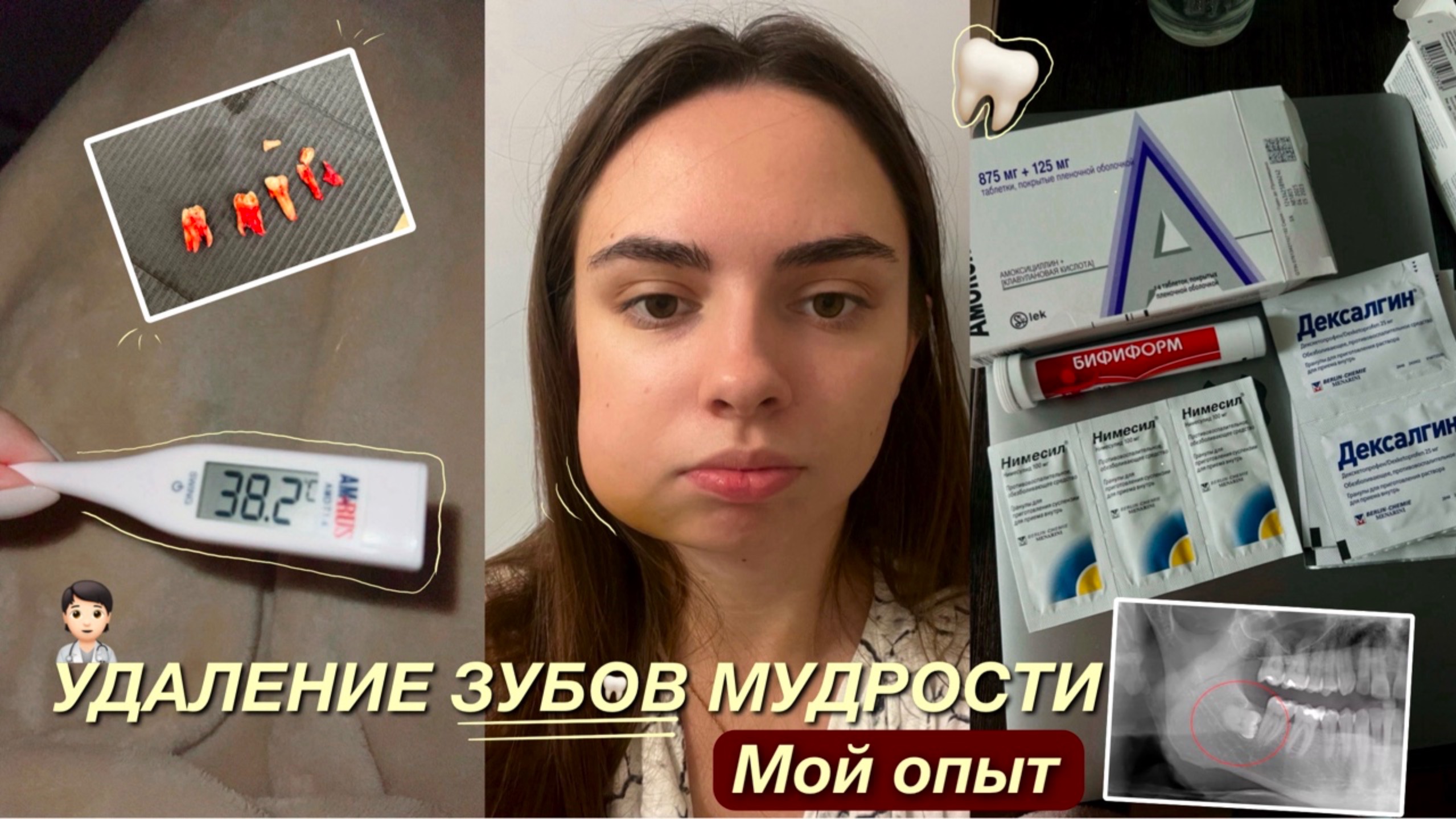 УДАЛЕНИЕ ЗУБОВ МУДРОСТИ| МОЙ ОПЫТ |НЕДЕЛЯ ВОССТАНОВЛЕНИЯ