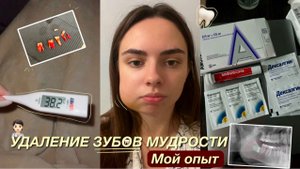 УДАЛЕНИЕ ЗУБОВ МУДРОСТИ| МОЙ ОПЫТ |НЕДЕЛЯ ВОССТАНОВЛЕНИЯ