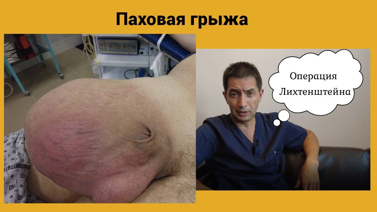 Паховая грыжа. Операция Лихтенштейна.