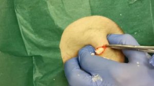 Massive 20 year Cyst Explosion. LipomaCyst.Com Dr Khaled Sadek