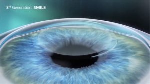 Коррекция зрения / операция методом ReLEx SMILE