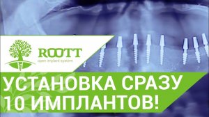 Имплантация всех зубов.💉 Как проходит операция по имплантации всех зубов. ROOTT.