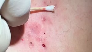 Large clogged pores emptied from chest area. Extraction techniques.Many curled ingrown hairs remove