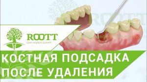 Костная подсадка. 💉 Операция подсадки костной ткани сразу после удаления зуба. ROOTT.