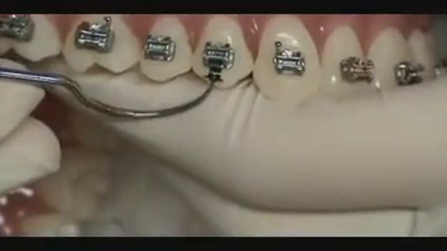 Замена клипсы брекетов Quick смотреть онлайн
