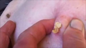 Pimple Popping! 🤢 Disgusting All the Way! 😄