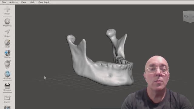 MeshMixer - Clear inner cavities on MRI reconstruction