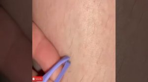 Award for Biggest Blackhead" and Juicy Cyst-Blackhead Removal-PART 1