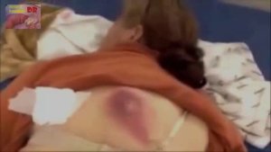 Pimple Popping Fix with Huge Cyst